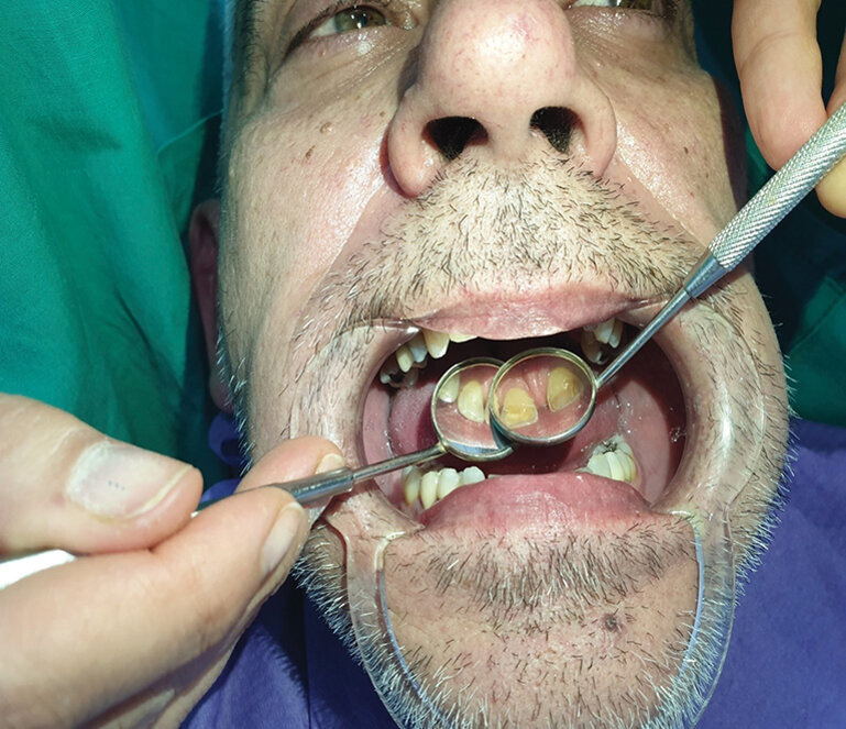 Sl. 1.3: Pacijent A, kontrola nakon 2 meseca od prelaska na bezdimni duvanski proizvod