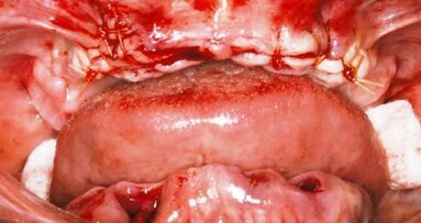 Zaopatrzenie implantologiczne i natychmiastowa odbudowa tymczasowa bezzębnych wyrostków – prezentacja przypadku