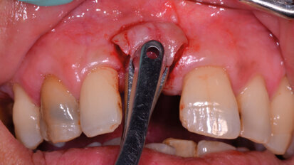 L’adherence al trattamento chirurgico, dopo l’igiene orale professionale. Case report