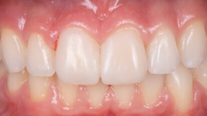 Facettes réalisées en méthode directe avec la technique du composite injecté