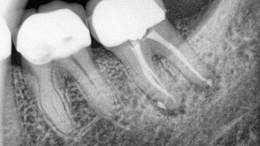 השפעת הארכת כותרת על שרידות שיניים אחוריות עם טיפול שורש כעבור עשר שנים
