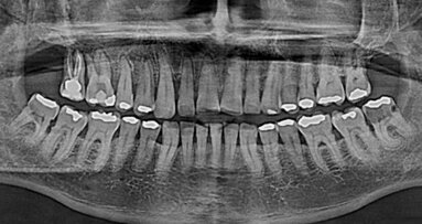 Complicaciones maxilofaciales en un paciente con cáncer de próstata