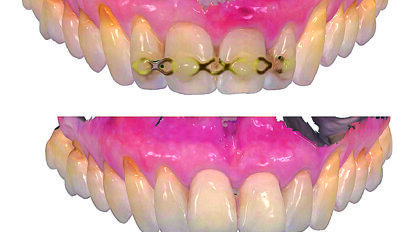 Estetska restauracija nakon traume prednjih zubi