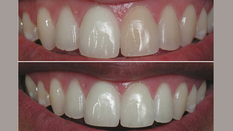 Sobre el blanqueamiento dental