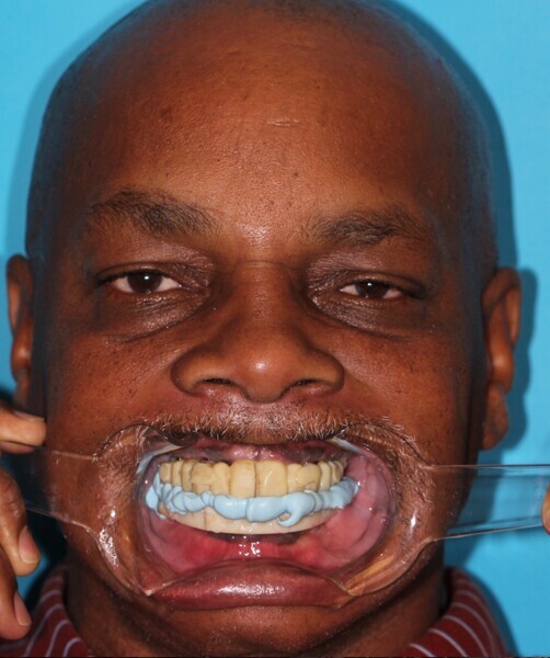 Fig. 20: Full-face retracted view of the centric relation bite registration with Blu-Mousse for the final impression using the acrylic transitional duplicates.