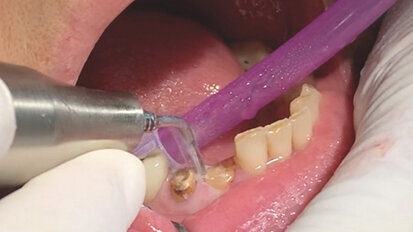 Figs. 4. Uso de los finos insertos para crear espacio entre hueso, ligamento y diente. Figs. 4. Uso de los finos insertos para crear espacio entre hueso, ligamento y diente.