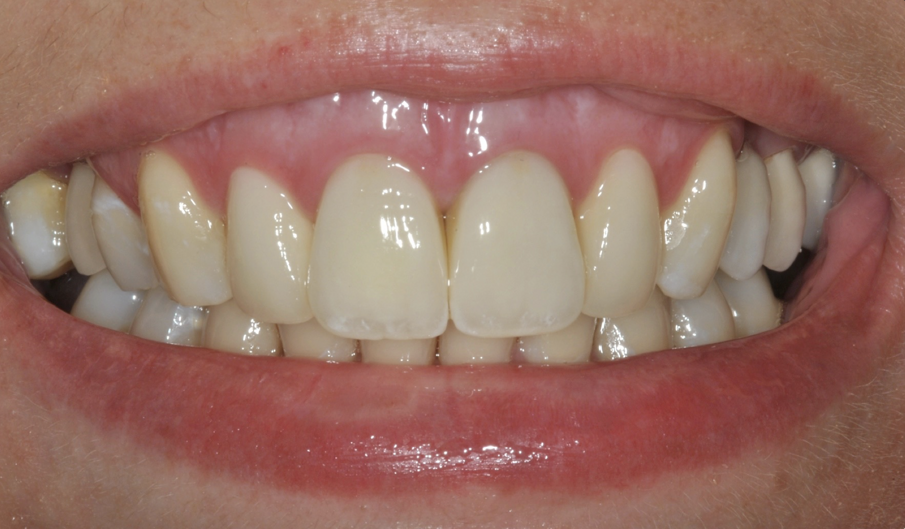 Fig. 14-16 - Il caso ultimato.