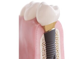 Dentsply Sirona – OsseoSpeed Profile EV