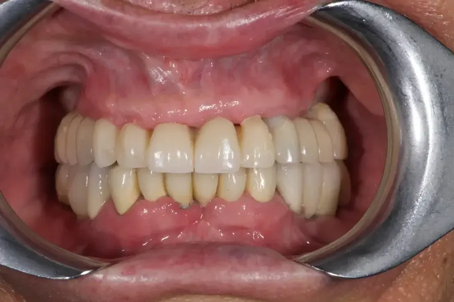 Фиг. 11: Временна протеза, подсилена с метал, фронтален изглед. 