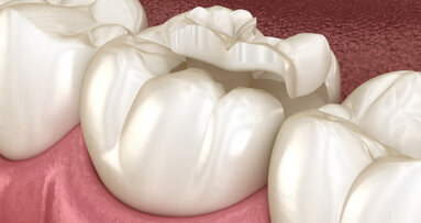 Langzeitbeobachtungsstudie zu Composite-Restaurationen