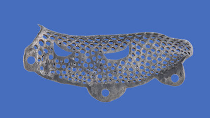 In 3D có vai trò ngày càng mở rộng trong cấy ghép