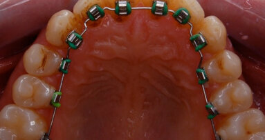 Cosmesi ortodontica con una apparecchiatura linguale 2D. Indicazioni, vantaggi e limiti