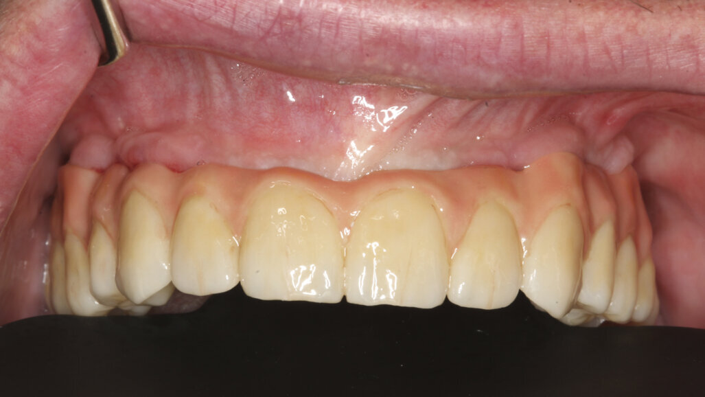 Immediate restoration of an edentulous maxilla