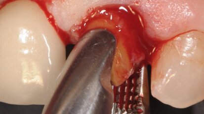 Impianto in zirconia post-estrattivo immediate