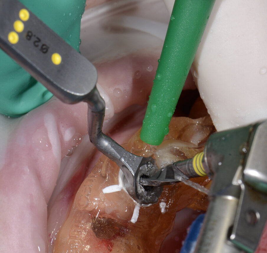 Fig. 25 - Preparazione letto implantare.