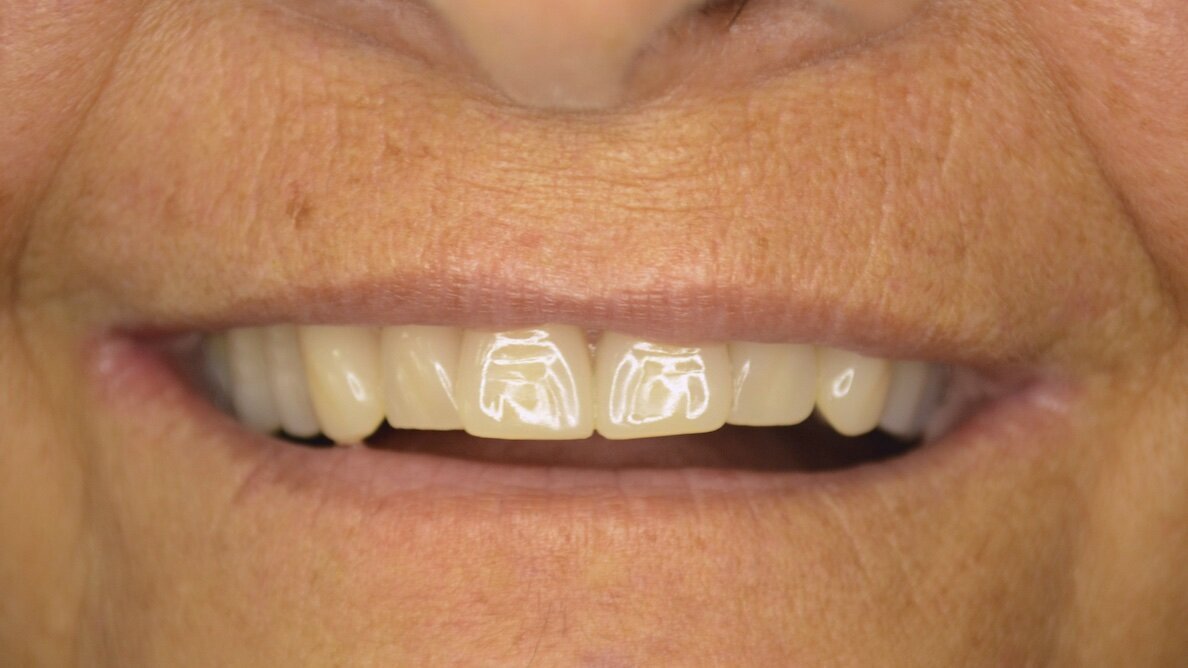 Implantología con anclaje extramaxilar