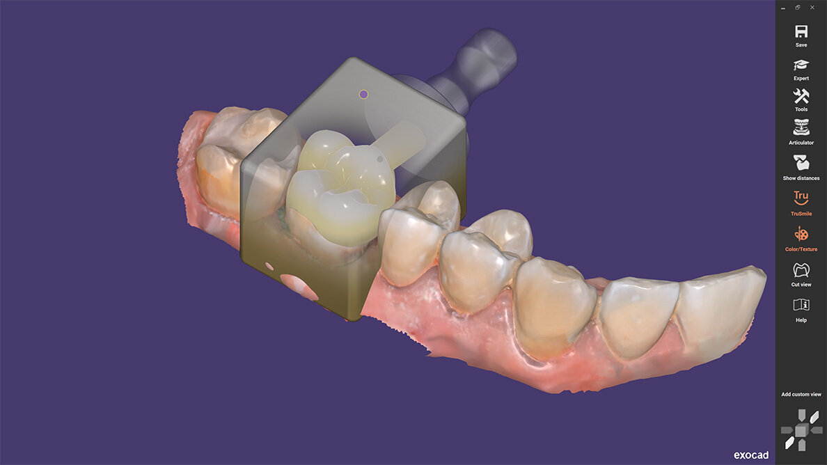 Exocad releases ChairsideCAD 3.0 Galway software for single-visit dentistry