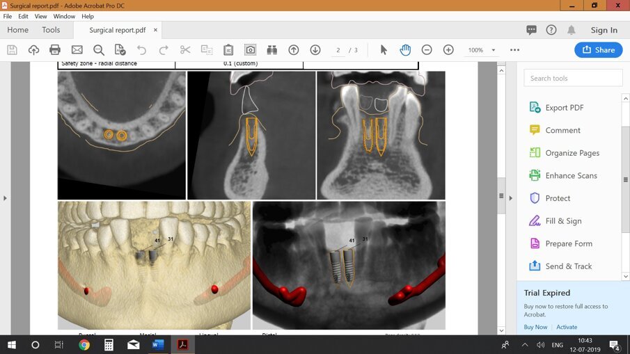 Fig 15: Digital Planning for implant surgery 