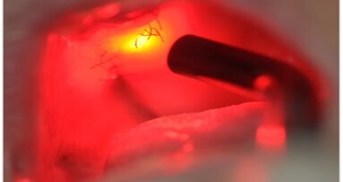 Osteonekroza występująca po zastosowaniu bisfosfonianów – opis przypadku