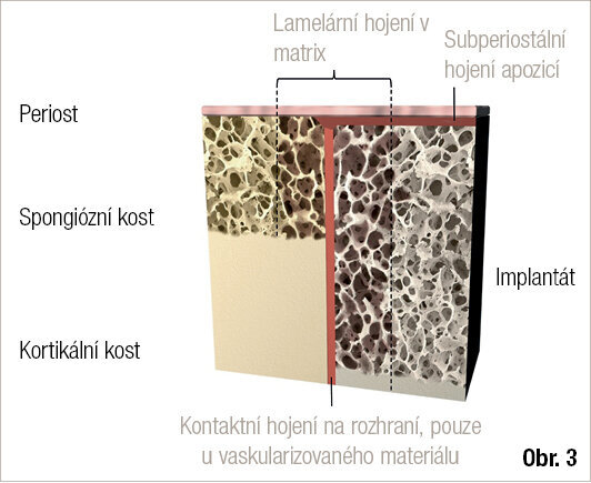 Souhrn hojení subperiostálního implantátu