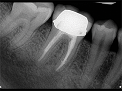 Slika 8: Kontrolna slika pokazuje brzo zarastanje i apikalne regije i resorptivne lezije. 