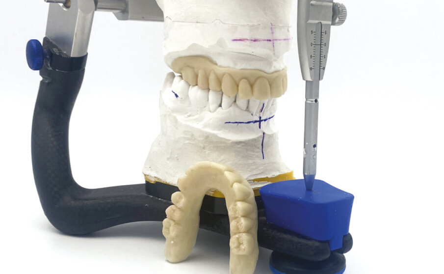 Fig. 4 - Due protesi in resina bianca: una diventerà il provvisorio immediato per il paziente, l’altra la dima protesica.