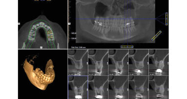 Complication du traitement du canal radiculaire et du sinus maxillaire