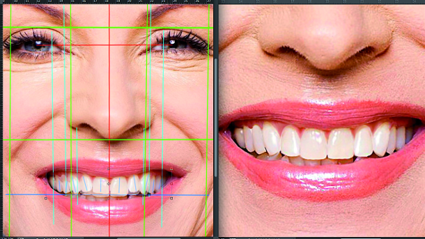 Aesthetic Digital Smile Design: Software-aided aesthetic dentistry—Part II