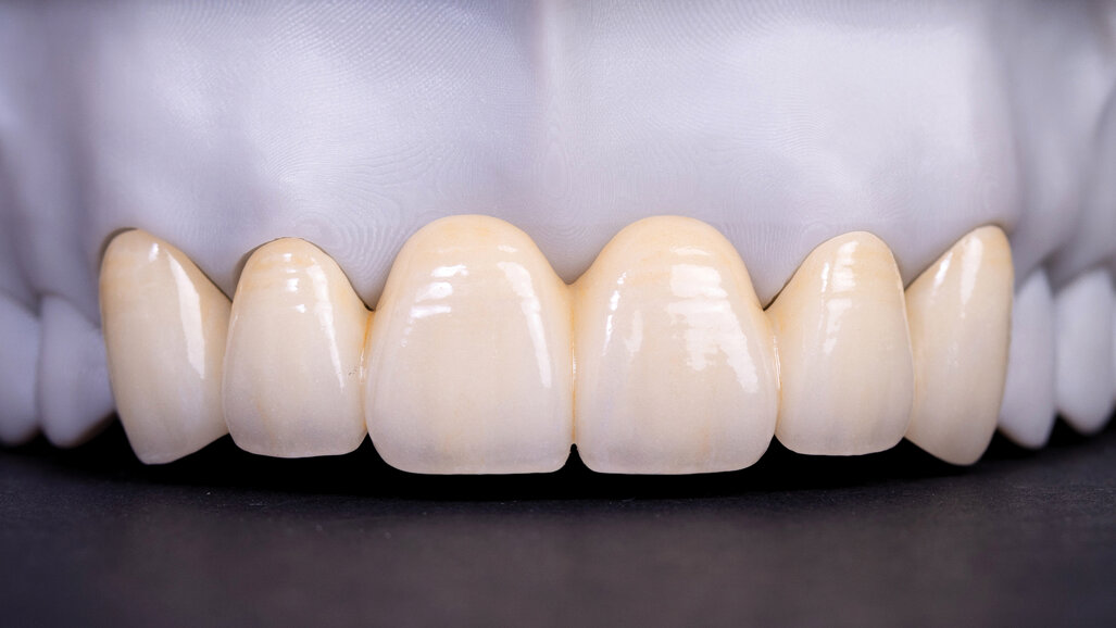 The growing opportunity in anterior esthetic dentistry