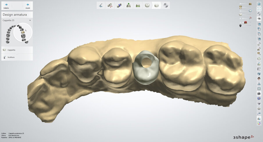Fig. 9 - Visione del progetto nel contesto del modello virtuale, si notino i punti di transizione nei contatti adiacenti e il foro della vite passante nella porzione occlusale, così da non compromettere l’estetica e la resistenza alle forze masticatorie.