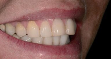 Indirect of direct restaureren: een binaire keuze?