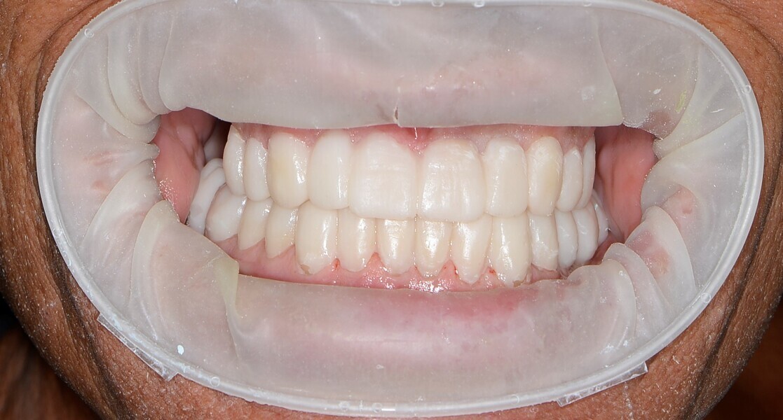 Figs. 24a–c: Mock-up for the restorative treatment, preparation for the veneers and wax occlusal check using the mock-up to in- crease the vertical dimension of occlusion.