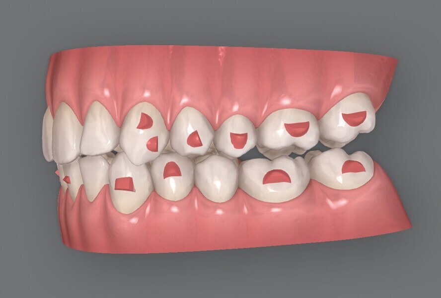 Fig. 5e : Plan supplémentaire du traitement par aligneurs conçu par ClinCheck (début). 