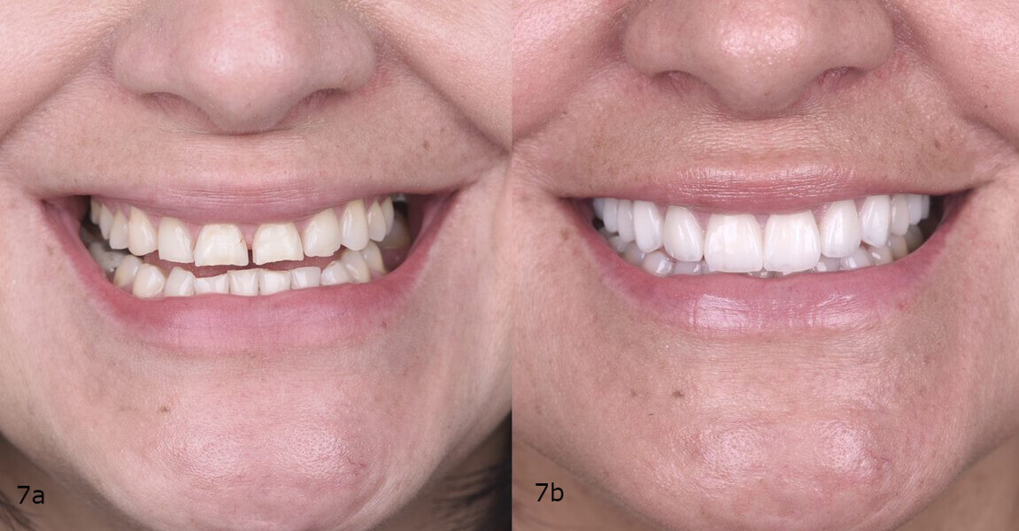 Figs. 7a & b: Pre-op (a) and post-op frontal views of the patient’s smile (b). 