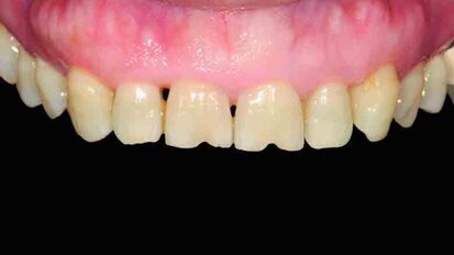 Chairside CAD/CAM immediate restorations