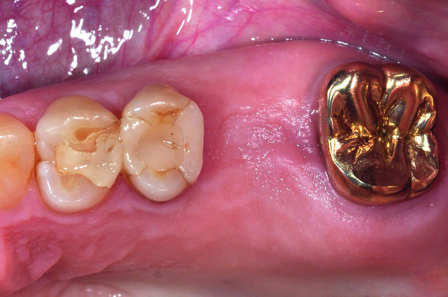 Fig. 1: Initial situation following the extraction of tooth 26 and healing phase.