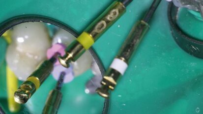 Problèmes endodontiques pressants