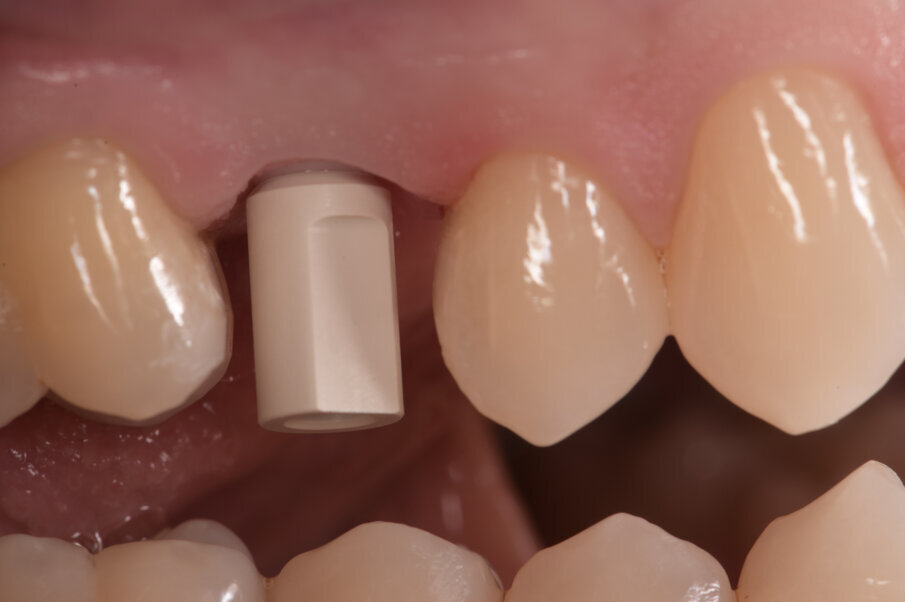 Fig. 6 - L’impronta definitiva viene rilevata secondo tecnica digitale con uno scanner intraorale (3Shape Trios). Usando il corpo di scansione proprio dell’impianto trasferiremo all’odontotecnico il file con le matematica proprie dell’impianto. L’impronta digitale permette inoltre un’eccellente lettura dei tessuti condizionati così da poter seguire i margini estetici realizzati. Lo scan-body si ferma sulla connessione implantare e non interferisce con i tessuti molli. 