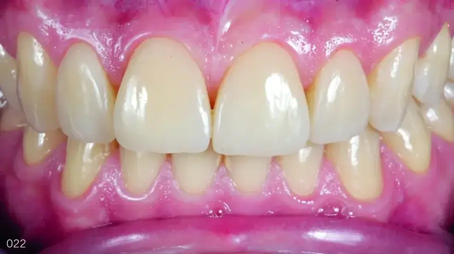 Фиг. 21 Зъби в интеркуспидация една година след лечението, фронтален изглед.