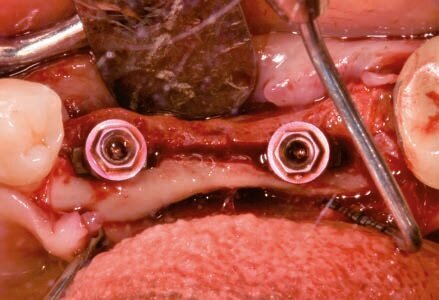 Fig. 11 - Inserimento implantare.