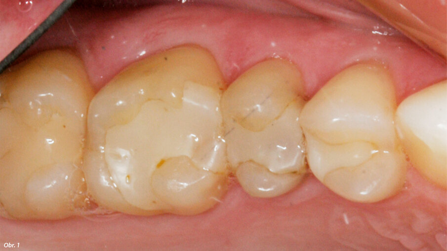 Výchozí situace zubů 16, 15 a 14 před preparací pro nepřímé keramické náhrady v důsledku destrukce recidivujícím kazem.