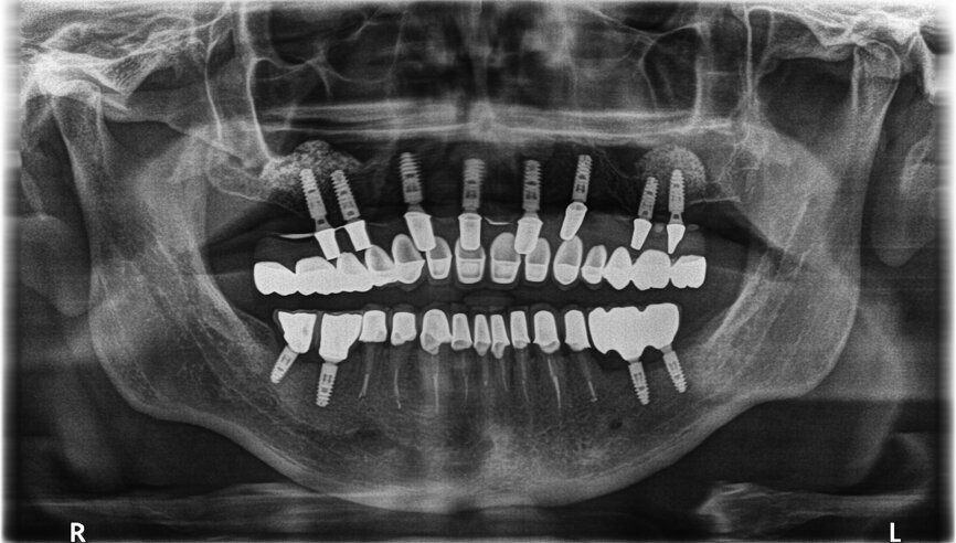 Fig. 32: OPG after treatment.