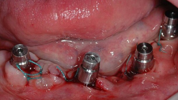 Uso del porta impronta dinamico nella protesi  a carico immediato