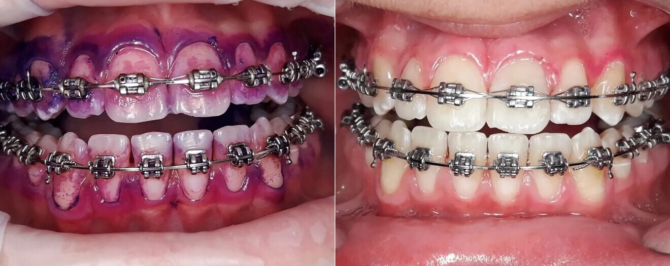 Guided Biofilm Therapy in the orthodontic practice. Situation after disclosure (left) and after treatment with the AIRFLOW Prophylaxis Master and PLUS powder from EMS (right). 