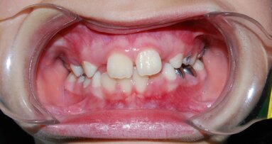 Abordaje odontológico del Síndrome de Prader-Willi: Desafíos y consideraciones clínicas