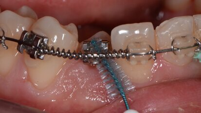 Il controllo del biofilm batterico nello spazio sovracrestale con approccio clinico personalizzato Tailored Brushing Method