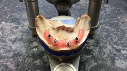 Rekonstrukcja implantoprotetyczna bezzębnej żuchwy