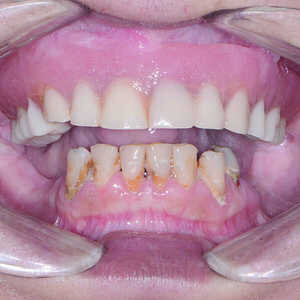 Fig-1-Vue-préopératoire-avec-écarteur-de-lèvres-300x300-