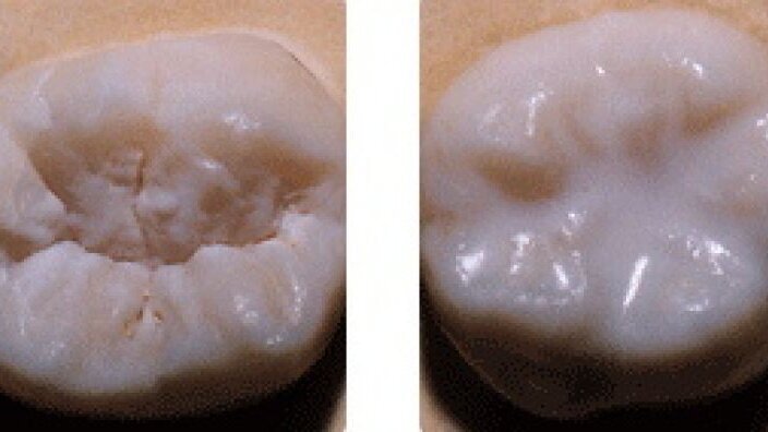 Sealants dentaires: plus seulement pour les enfants