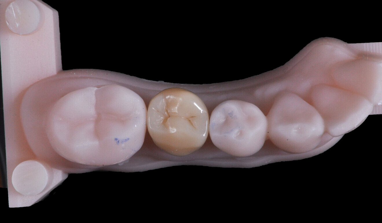 Fig. 11: Hybrid ceramic overlay on the printed model. 